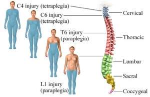 Spinal Cord Injury Lawyer in Miami, FL