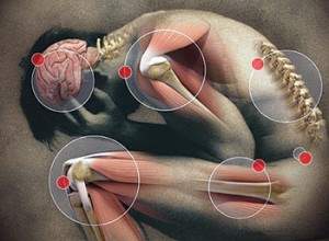 Soft Tissue Damage Injury Lawyer in Miami, FL